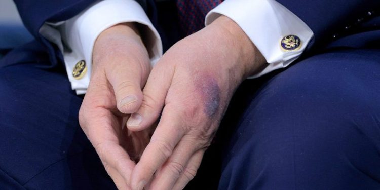 White House explains bruise on Trump’s hand